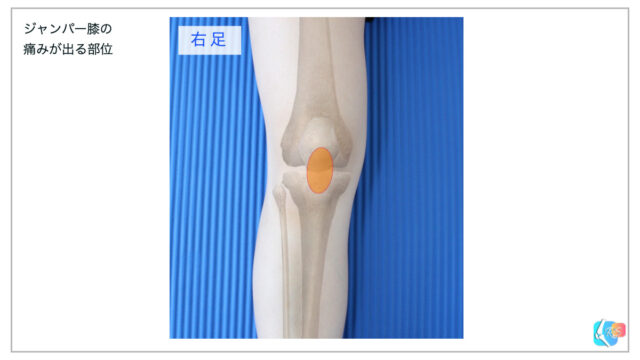 膝蓋靱帯炎の圧痛